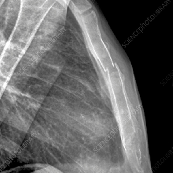 sternum