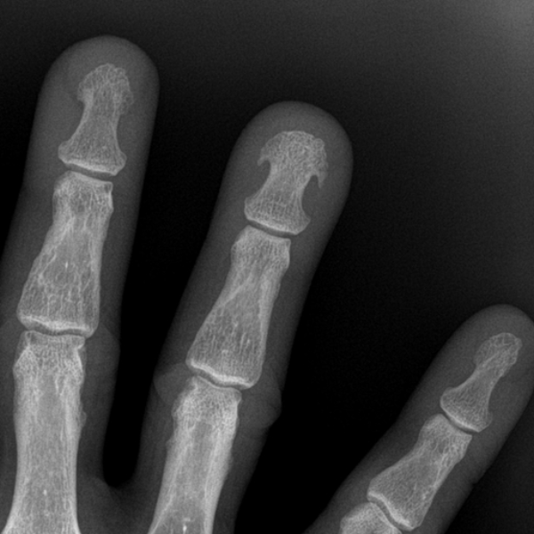 distal phalange
