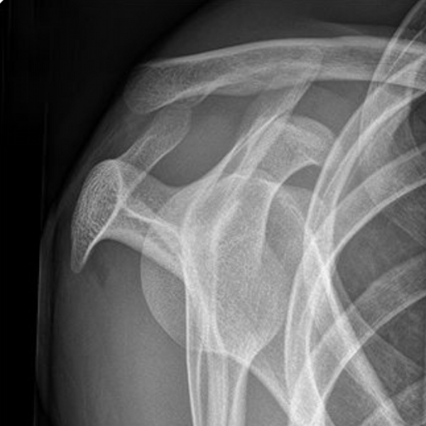 scapula