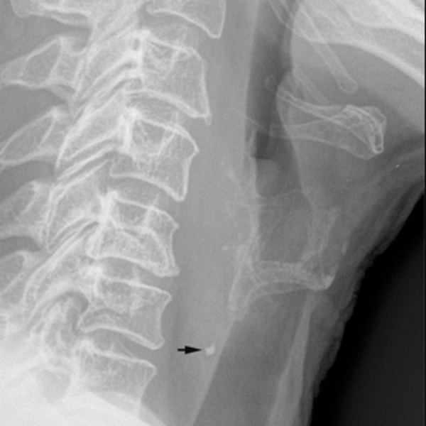 hyoid