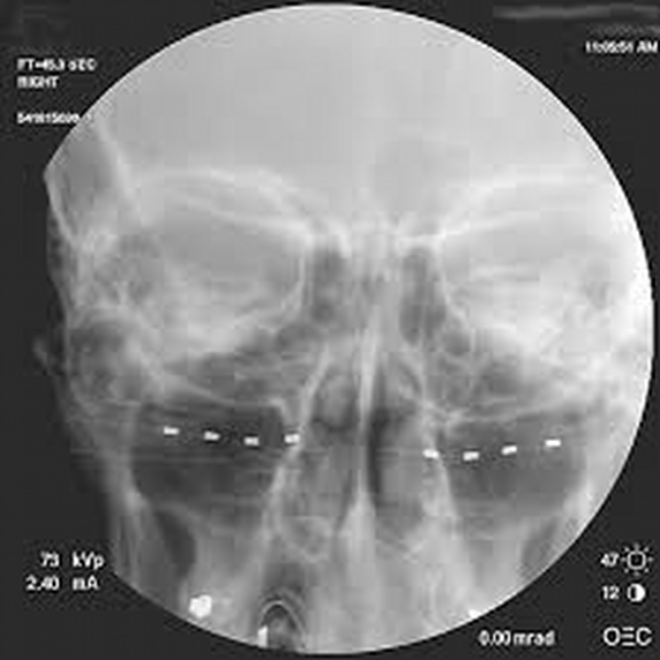 occipital