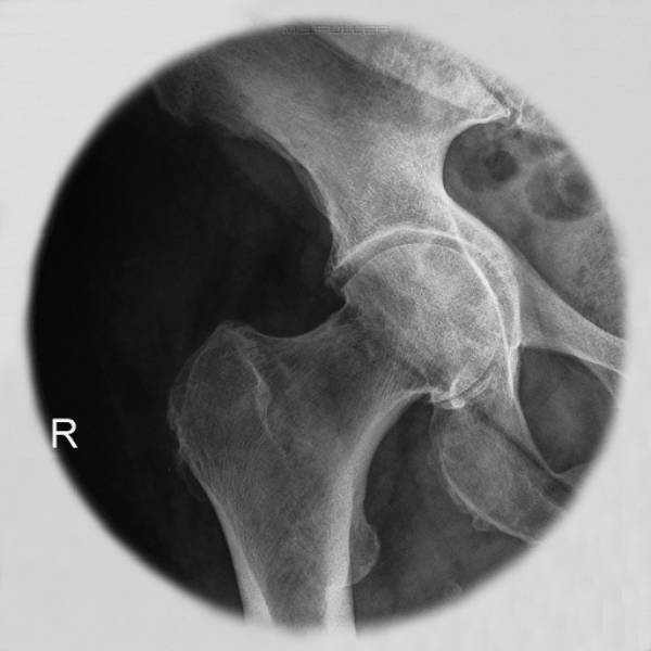 ischium