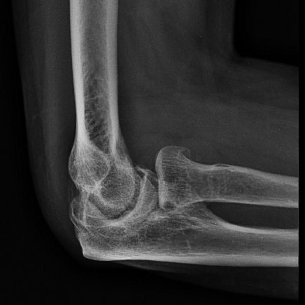 ulna