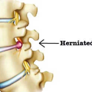 Herniated Disco