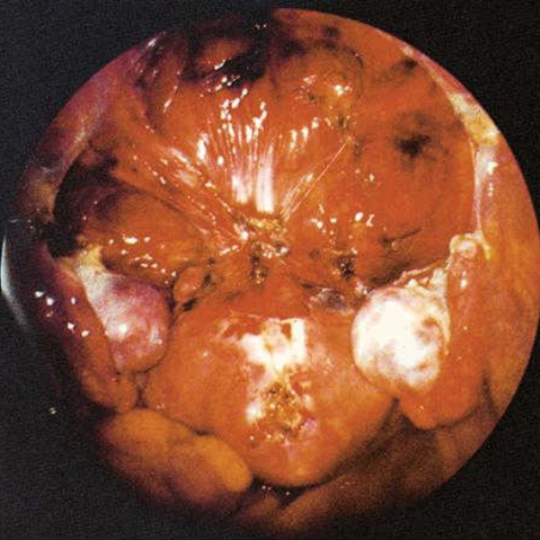 histerektomia