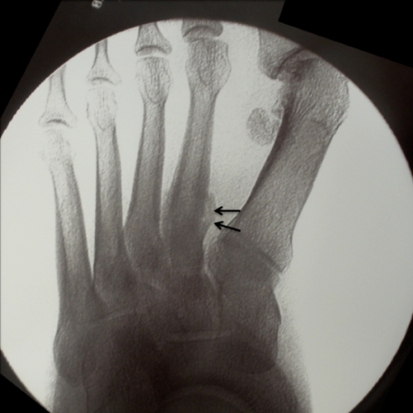 metatarsal 2