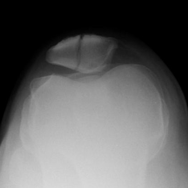 patella