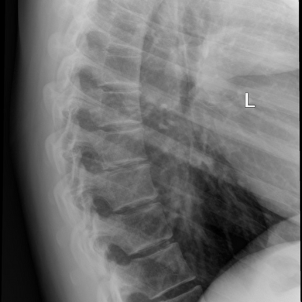 thoracic vertebrae 1