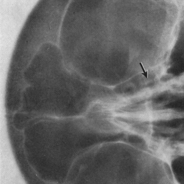 lacrimal