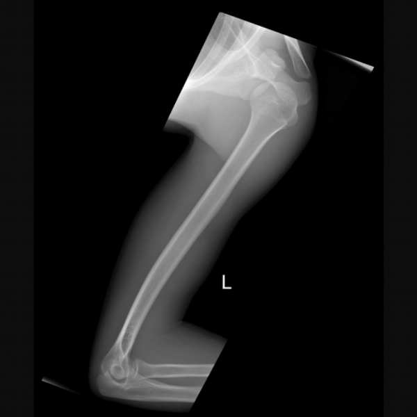 humerus