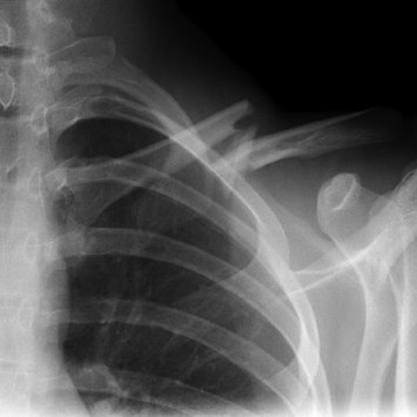 clavicle